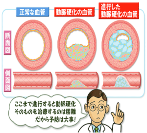 生活習慣病とは