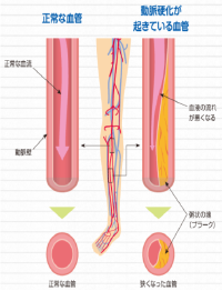 閉塞性動脈硬化症とは