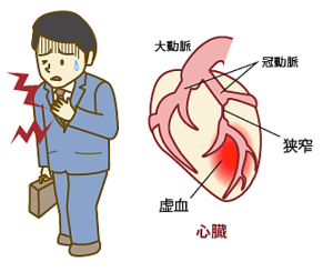 狭心症とは