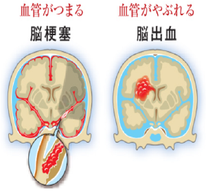 脳卒中とは