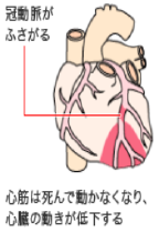 心筋梗塞とは